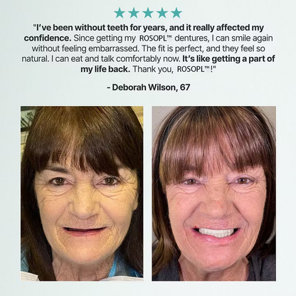 🔥🔥70% OFF🏆 Cheeroll™ Natural Smile Upgrade🦷