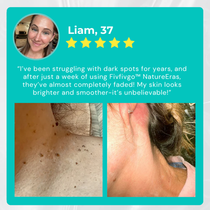 NatureErase: Erase Unwanted Marks in 7 Days Without Surgery, Pain, or $650 Doctor Bills